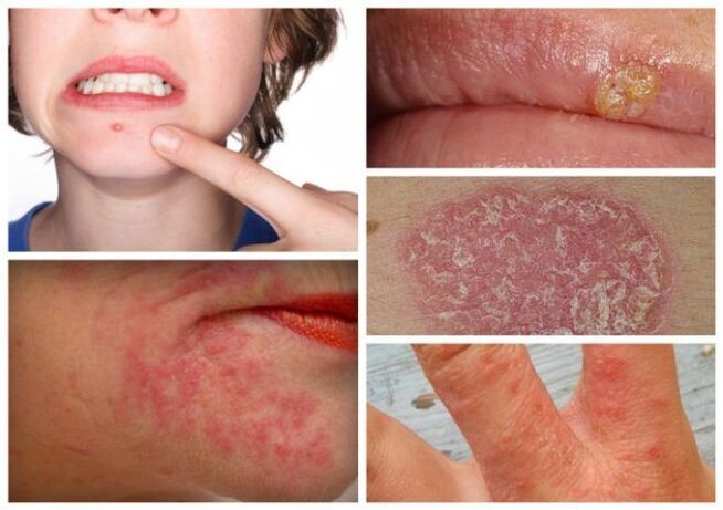 Alergjitë dhe sëmundjet e lëkurës janë shenja të parazitëve në trup