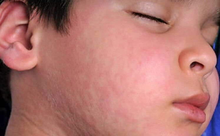 Skuqjet alergjike në lëkurë - një simptomë e pranisë së krimbave parazitarë në trup